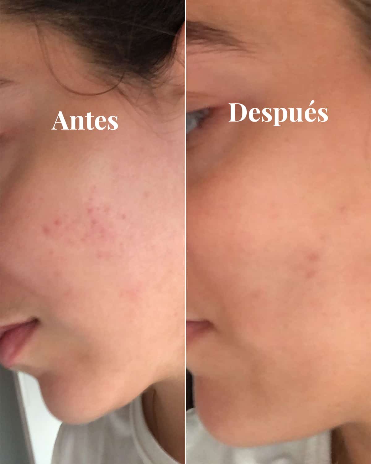 Anti-blemish Brightening Serum, 30 ml